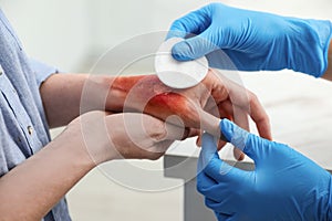 Doctor covering patient`s burn of hand with cotton pad indoors, closeup