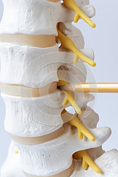 Doctor demonstrating lumbar spine intervertebral disc model
