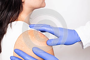 Doctor dermatologist conducts medical examination of problem skin on the patient`s shoulder, pigment spots on the skin, melanin