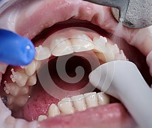 Doctor doing professional teeth cleaning in dental clinic
