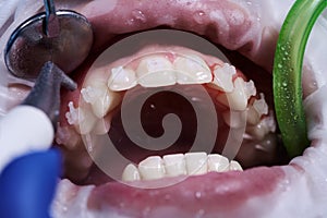 Doctor doing professional teeth cleaning in dental clinic photo