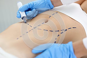 Doctor drawing preoperative marking on patient abdomen closeup