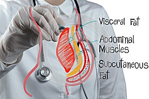Doctor draws abdominal fat