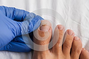 A doctor examines bare foot with onycholysis on a toenail after damaging with tight shoes or using gel-lacquer photo