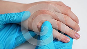 Doctor examines a child hand affected by viral warts Verruca vulgaris, close-up. Papillomavirus, HPV. Pediatric