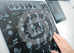 Doctor examines the CT picture on negatoscope
