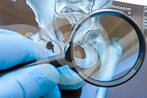 Doctor examines MRI snapshot of hip joint with magnifying glass. Careful diagnosis rare and occurs widely hip joint diseases such photo