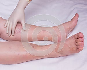 Doctor examines the patient`s legs for the presence and degree of varicose veins in the legs, close-up, white background