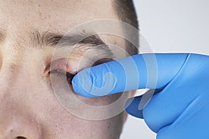 A doctor examines a patient who has blepharitis. Treatment of inflammation and redness of the eyelid. Infection of the skin around