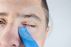 A doctor examines a patient who has blepharitis. Treatment of inflammation and redness of the eyelid. Infection of the skin around