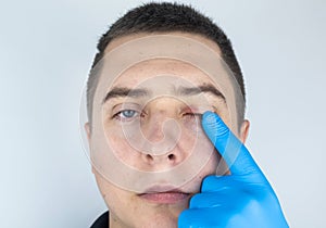 A doctor examines a patient who has blepharitis. Treatment of inflammation and redness of the eyelid. Infection of the skin around