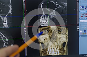 The doctor examines a X-ray examination of the maxillofacial region of the head on a computer monitor.