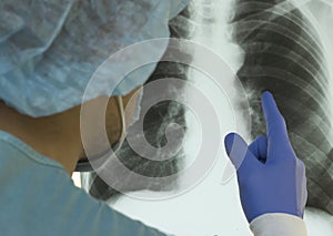 A doctor examines an X-ray of a patient s lung infected with covid-19 coronavirus