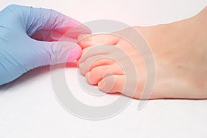 Doctor examines a sore toe infected with fungal infection, close-up, onychomycosis, medical photo