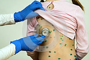 Doctor examining a child with stethoscope covered with green rashes on back ill with chickenpox, measles or rubella virus