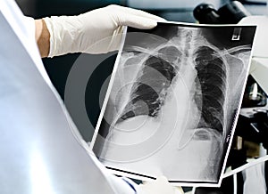 Doctor examining a lung radiography, Doctor looking chest x-ray film.