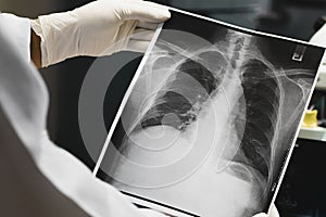 Doctor examining a lung radiography, Doctor looking chest x-ray film.