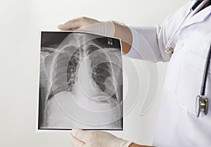 Doctor examining a lung radiography.