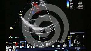 Doctor examining a patient`s heart. Echocardiogram