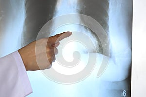 Doctor hand pointing on chest x-ray film, Medicine concept