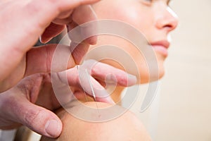 Doctor hands acupuncture needle pricking on woman