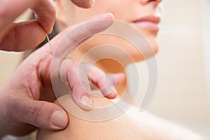 Doctor hands acupuncture needle pricking on woman photo