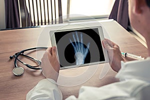 Doctor holding a digital tablet with x-ray of left hand. Osteoarthritis concept