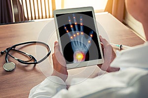 Doctor holding a digital tablet with x-ray of a left hand with pain on the joints of the fingers and wrist. Osteoarthritis concept