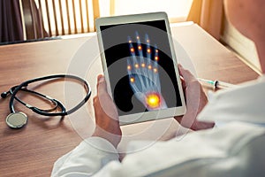 Doctor holding a digital tablet with x-ray of a right hand with osteoarthritis pain on the joints of the fingers and wrist