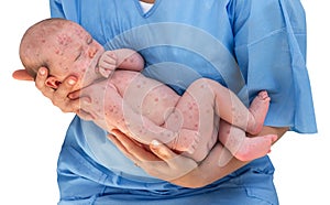 Doctor holding a newborn baby which is sick rubella photo