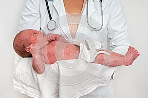 Doctor holding a newborn baby which is sick rubella or measles