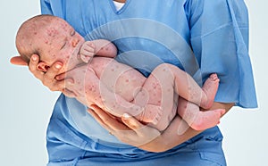 Doctor holding a newborn baby which is sick rubella or measles photo