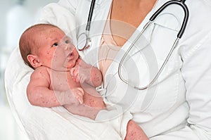 Doctor holding a newborn baby which is sick rubella or measles photo