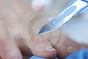 Doctor holding scalpel over corn on womans leg closeup