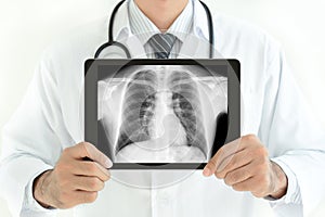 Doctor holding tablet pc with normal male chest x-ray image