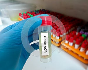 Urine Sample for Urine ACR (Albumin creatinine Ratio). Diagnosis of renal Kidney disease.