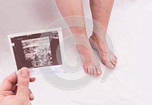 Doctor holds in his hand the result of an ultrasound scan of veins with thrombosis in an elderly woman, close-up, white background