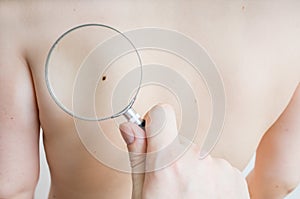 Doctor holds magnifying glass in hand and is examining patient skin for melanoma.