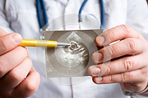 Doctor holds snapshot of ultrasound of heart and indicates with ballpoint pen on possible pathology of heart aortic valve. Concept