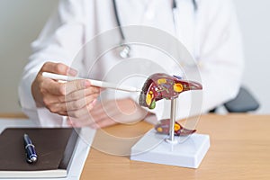 Doctor with human Liver anatomy model. Liver cancer and Tumor, Jaundice, Viral Hepatitis A, B, C, D, E, Cirrhosis, Failure,