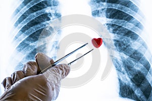 Doctor or lab technician in a white glove holding tweezers a souvenir heart over a chest X-ray. Concept of love or illness,