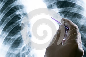 A doctor or laboratory assistant in a white glove is holding a pointer over a chest x-ray. Concept of tuberculosis disease