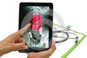 Doctor looking lumbar spine x-ray image on tablet