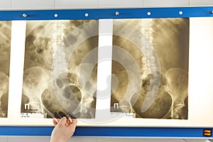 Doctor looking at x-ray photo of pelvis