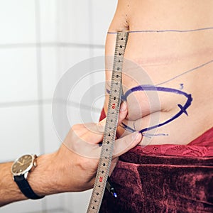 Doctor measuring woman belly with ruler before abdominoplasty. photo