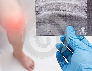 Doctor in medical glove keeps ultrasound of woman`s knee, knee pain, inflammation, close-up, patient photo