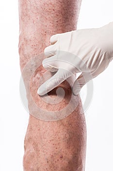 Doctor in medical gloves examines a person with varicose veins o