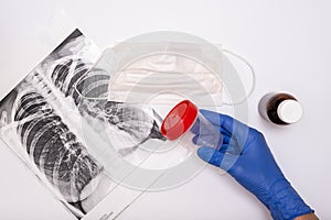A doctor in medical gloves holding an analysis container, an x-ray of lungs, face mask and medicine is on the table, pneumonia and