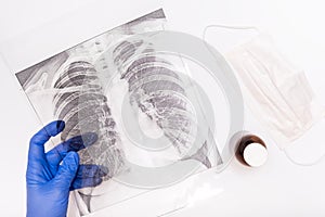 A doctor in medical gloves holding an x-ray of lungs, pneumonia and bronchitis concept photo