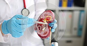 Doctor or nurse shows model of kidney closeup